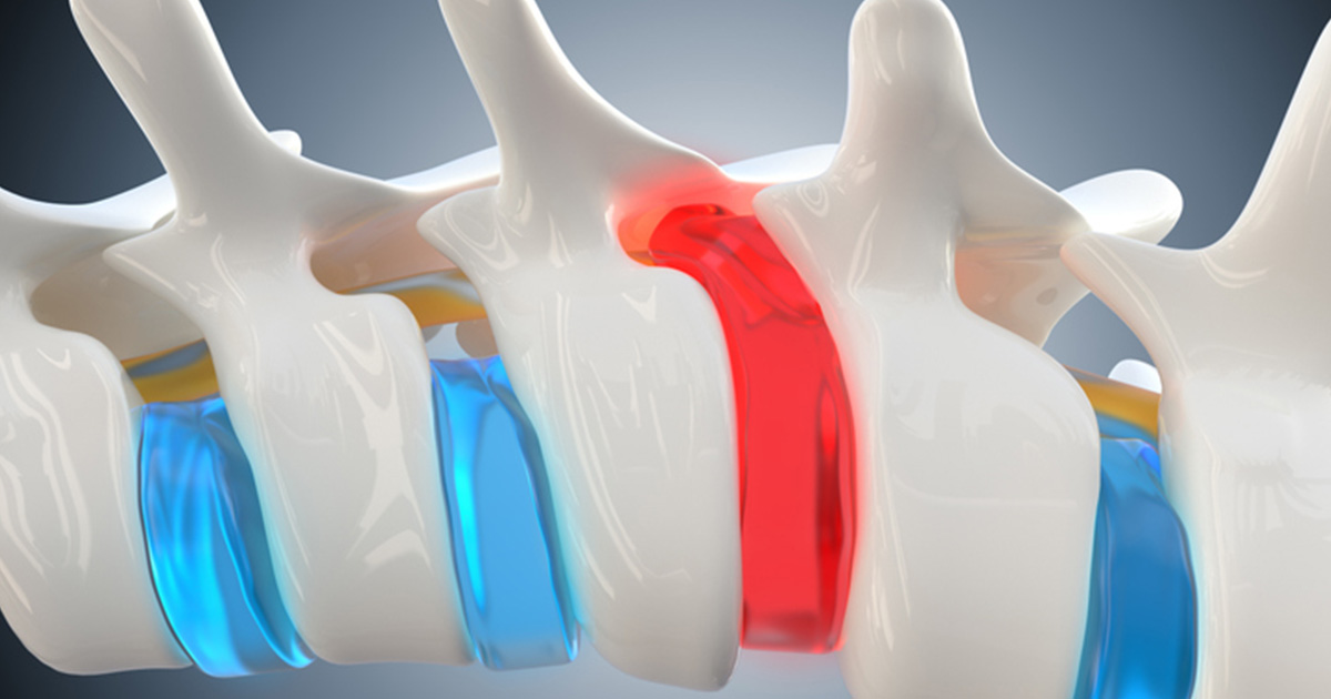 Degenerative Disc Disease: What It Actually Means and What You Can Do About It