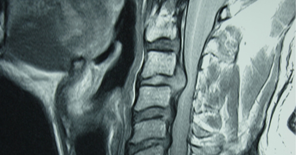 The Truth About Herniated Discs: What Your MRI Actually Means